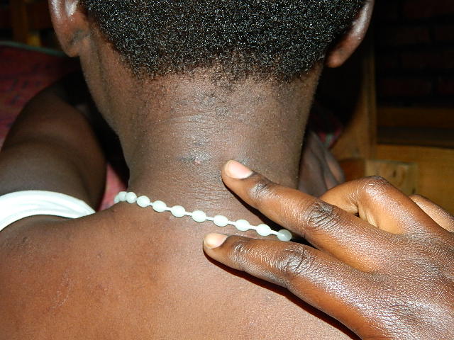 Imibiri ya bamwe yazanye amabara kubera kurumwa