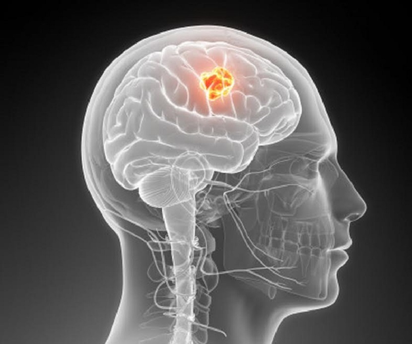 Glioblastoma ni kanseri y'ubwonko yica 95% by'abayirwaye mu gihe kitarenze imyaka itanu