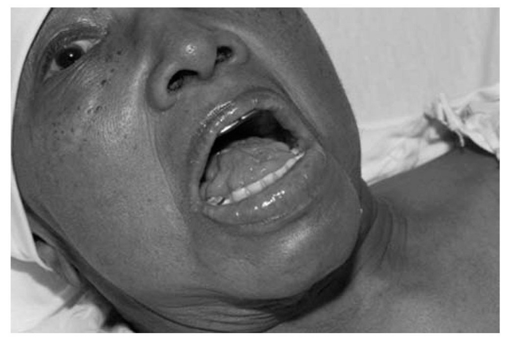 Umuntu urwaye ‘Dysarthria’ akoresha imbaraga nyinshi mu kuvuga azi ko ari bwo yumvwa