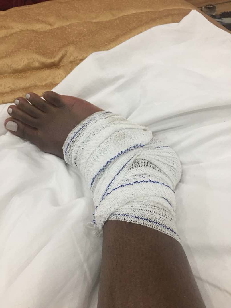 Muthoni yavunitse ikirenge cy'iburyo