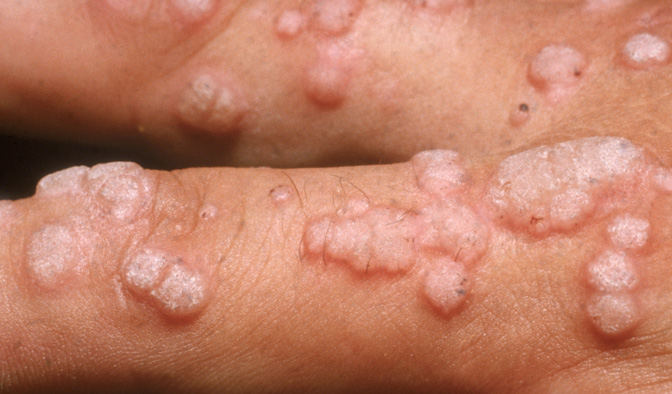 Abanyamerika miliyoni 80 banduye bumwe mu bwoko bwa virusi ya HPV itera kanseri/ Ifoto: Internet