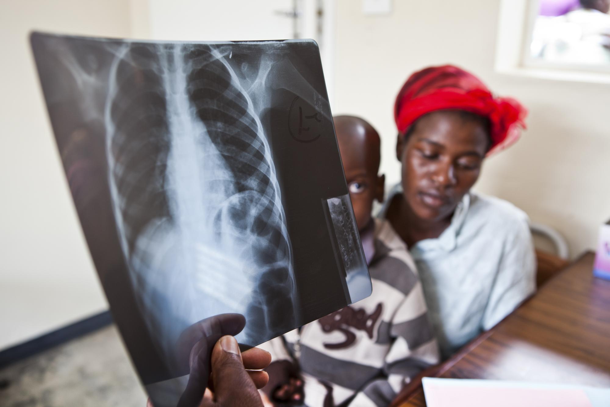 Mu 2020/21 mu Rwanda abarenga 5000 basanzwemo indwara y'igituntu.