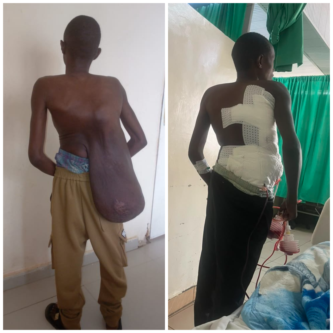 Yari amaranye ikibyimba imyaka 15: Uko abaganga ba CHUK bakibaze gipima ibilo 15 (Video)